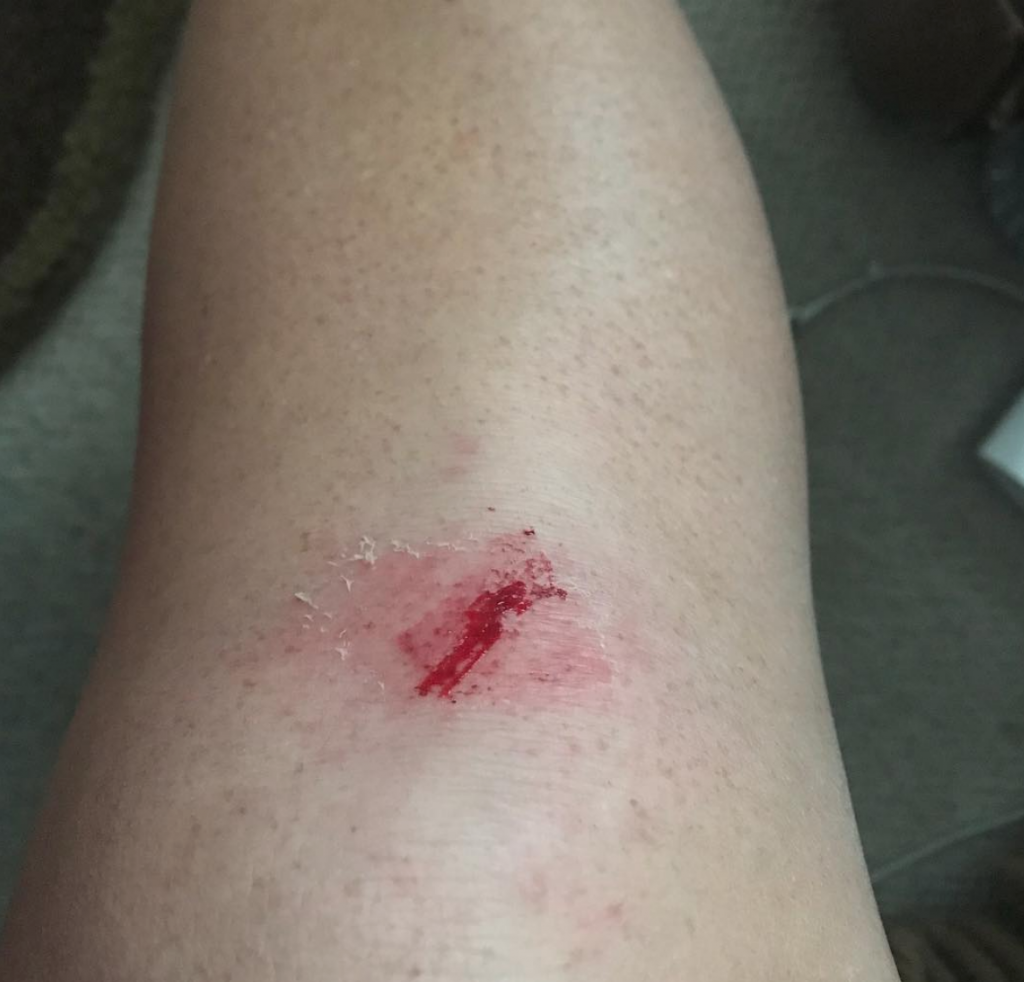 Cut on my lef from getting dehydrated